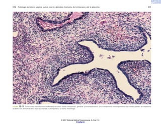 C12 Patología del útero, vagina, vulva, ovario, glándula mamaria, del embarazo y de la placenta 311
FIGURA 12-13. Tumor mixto mesodérmico (mülleriano) del útero. Doble componente, glandular y mesenquimatoso. En el componente mesenquimatoso hay células grandes de citoplasma
acidófilo con diferenciación a músculo estriado. Corresponde a un tumor heterólogo.
© 2007 Editorial Médica Panamericana, S.A de C.V.
Cisfarm
 