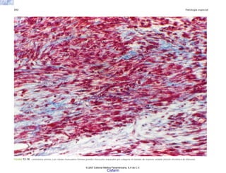 312 Patología especial
FIGURA 12-14. Leiomioma uterino. Las células musculares forman grandes fascículos separados por colágena en bandas de espesor variable (tinción tricrómica de Masson).
© 2007 Editorial Médica Panamericana, S.A de C.V.
Cisfarm
 