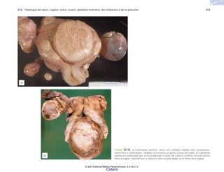 C12 Patología del útero, vagina, vulva, ovario, glándula mamaria, del embarazo y de la placenta 313
FIGURA 12-15. a) Leiomiomas uterinos. Útero con múltiples nódulos bien circunscritos,
subserosos e intramurales. También se reconoce un quiste seroso del ovario. b) Leiomioma
submucoso pediculado que se ha prolapsado a través del canal y el orificio cervical externo
hasta la vagina. Clínicamente se observa como un gran pólipo en el fondo de la vagina.
(b)
(a)
© 2007 Editorial Médica Panamericana, S.A de C.V.
Cisfarm
 