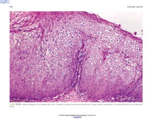 314 Patología especial
FIGURA 12-16. Imagen histológica de un condiloma del cérvix. El epitelio es grueso y hay extensa coilocitosis en capas medias y superficiales, así como proliferación de las células pro-
fundas.
© 2007 Editorial Médica Panamericana, S.A de C.V.
Cisfarm
 