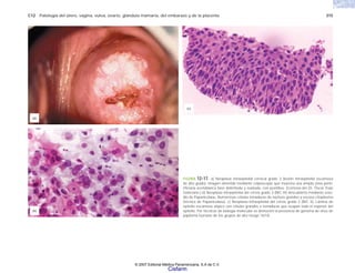 C12 Patología del útero, vagina, vulva, ovario, glándula mamaria, del embarazo y de la placenta 315
FIGURA 12-17. a) Neoplasia intraepitelial cervical grado 3 (lesión intraepitelial escamosa
de alto grado). Imagen obtenida mediante colposcopio que muestra una amplia zona perio-
rificiaria acetoblanca bien delimitada y realzada, con puntilleo. (Cortesía del Dr. Óscar Trejo
Solórzano.) b) Neoplasia intraepitelial del cérvix grado 3 (NIC III) descubierta mediante estu-
dio de Papanicolaou. Numerosas células inmaduras de núcleos grandes y escaso citoplasma
(técnica de Papanicolaou). c) Neoplasia intraepitelial del cérvix grado 2 (NIC II). Lámina de
epitelio escamoso atípico con células grandes e inmaduras que ocupan todo el espesor del
epitelio. Por técnicas de biología molecular se demostró la presencia de genoma de virus de
papiloma humano de los grupos de alto riesgo 16/18.
(a)
(b)
(c)
© 2007 Editorial Médica Panamericana, S.A de C.V.
Cisfarm
 