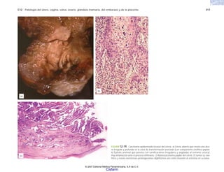 C12 Patología del útero, vagina, vulva, ovario, glándula mamaria, del embarazo y de la placenta 317
FIGURA 12-19. Carcinoma epidermoide invasor del cérvix. a) Cérvix abierto que revela una úlce-
ra irregular y profunda en la zona de transformación asociada a un componente exofítico papilar.
b) Epitelio anormal que penetra con ramificaciones irregulares y anguladas al estroma cervical.
Hay inflamación ante el proceso infiltrante. c) Adenocarcinoma papilar del cérvix. El tumor es exo-
fítico y revela numerosas prolongaciones digitiformes así como invasión al estroma en su base.
(b)
(c)
(a)
© 2007 Editorial Médica Panamericana, S.A de C.V.
Cisfarm
 