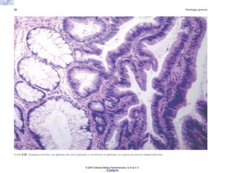 30 Patología general
FIGURA 2-22. Metaplasia intestinal. Las glándulas del colon (izquierda) se transforman en glándulas con aspecto de intestino delgado (derecha).
© 2007 Editorial Médica Panamericana, S.A de C.V.
Cisfarm
 
