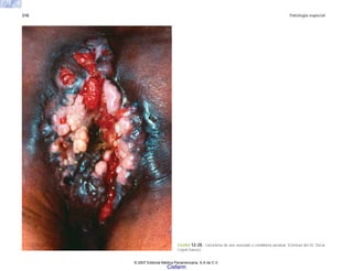 318 Patología especial
FIGURA 12-20. Carcinoma de ano asociado a condiloma perianal. (Cortesía del Dr. Óscar
Coyoli García.)
© 2007 Editorial Médica Panamericana, S.A de C.V.
Cisfarm
 