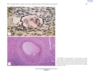 C12 Patología del útero, vagina, vulva, ovario, glándula mamaria, del embarazo y de la placenta 319
FIGURA 12-21. a) Folículo primordial. La célula germinal y ovogonia
—que en este caso es multinucleada— aparece rodeada por una fina
capa de células de la granulosa. En torno al folículo se observan fibro-
blastos del estroma ovárico. b) Folículo de Graaf cavitado y constituido
por una colección central de células de la granulosa que rodea al óvulo.
El estroma circundante aparece condensado y se encuentra constituido
por células de la teca.
(a)
(b)
© 2007 Editorial Médica Panamericana, S.A de C.V.
Cisfarm
 
