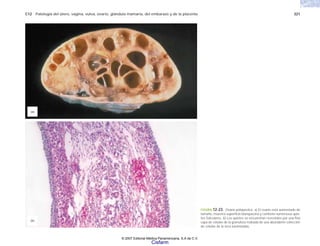 C12 Patología del útero, vagina, vulva, ovario, glándula mamaria, del embarazo y de la placenta 321
FIGURA 12-23. Ovario poliquístico. a) El ovario está aumentado de
tamaño, muestra superficie blanquecina y contiene numerosos quis-
tes foliculares. b) Los quistes se encuentran revestidos por una fina
capa de células de la granulosa rodeada de una abundante colección
de células de la teca luteinizadas.
(a)
(b)
© 2007 Editorial Médica Panamericana, S.A de C.V.
Cisfarm
 
