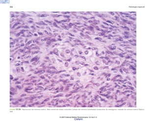 322 Patología especial
FIGURA 12-24. Hipertecosis del estroma ovárico. Nido central de células esteroides (células del estroma luteinizadas) productoras de andrógenos, rodeado de estroma ovárico hiperce-
lular.
© 2007 Editorial Médica Panamericana, S.A de C.V.
Cisfarm
 