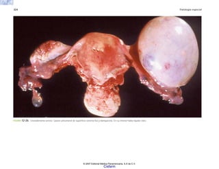 324 Patología especial
FIGURA 12-26. Cistoadenoma seroso. Quiste unicameral de superficie externa lisa y blanquecina. En su interior había líquido claro.
© 2007 Editorial Médica Panamericana, S.A de C.V.
Cisfarm
 