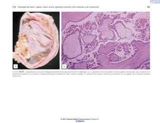 C12 Patología del útero, vagina, vulva, ovario, glándula mamaria, del embarazo y de la placenta 325
FIGURA 12-27. Cistoadenoma seroso de malignidad borderline (de bajo potencial de malignidad). a) La superficie interna del quiste muestra papilas blanquecinas que resultan de la
proliferación epitelial. b) Se observa marcada proliferación epitelial con nidos celulares aislados. El estroma tiene aspecto uniforme y edematoso en las papilas. No se observa invasión
destructiva.
(a) (b)
© 2007 Editorial Médica Panamericana, S.A de C.V.
Cisfarm
 