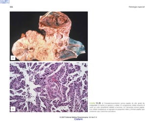 326 Patología especial
FIGURA 12-28. a) Cistoadenocarcinoma seroso papilar de alto grado de
malignidad. El tumor es quístico y sólido. El componente sólido muestra al
corte un color amarillento debido a necrosis. b) Carcinoma seroso papilar.
Las células neoplásicas se agrupan en pequeños nidos y forman papilas que
contienen ejes conectivo-vasculares.
(a)
(b)
© 2007 Editorial Médica Panamericana, S.A de C.V.
Cisfarm
 