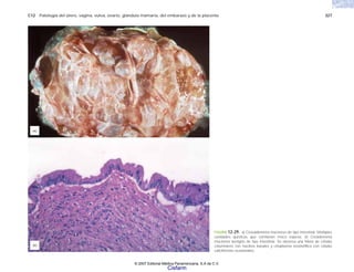 C12 Patología del útero, vagina, vulva, ovario, glándula mamaria, del embarazo y de la placenta 327
FIGURA 12-29. a) Cistoadenoma mucinoso de tipo intestinal. Múltiples
cavidades quísticas que contienen moco espeso. b) Cistadenoma
mucinoso benigno de tipo intestinal. Se observa una hilera de células
columnares con núcleos basales y citoplasma eosinofílico con células
caliciformes ocasionales.
(b)
(a)
© 2007 Editorial Médica Panamericana, S.A de C.V.
Cisfarm
 