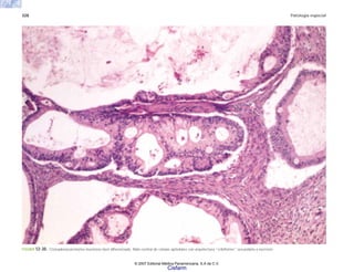 328 Patología especial
FIGURA 12-30. Cistoadenocarcinoma mucinoso bien diferenciado. Nido central de células apiteliales con arquitectura “cribiforme” secundaria a necrosis.
© 2007 Editorial Médica Panamericana, S.A de C.V.
Cisfarm
 