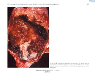 C12 Patología del útero, vagina, vulva, ovario, glándula mamaria, del embarazo y de la placenta 329
FIGURA 12-31. Seudomixoma peritoneal en una paciente de 41 años de edad con
antecedentes de cistadenoma mucinoso ovárico de tipo intestinal resecado seis años
antes. Se observa una abundante colección de material mucoide que rodea las vísceras
abdominales.
© 2007 Editorial Médica Panamericana, S.A de C.V.
Cisfarm
 