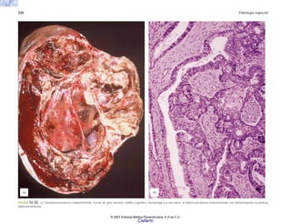 330 Patología especial
FIGURA 12-32. a) Citoadenocarcinoma endometrioide. Tumor de gran tamaño, sólido y quístico, hemorrágico y necrótico. b) Adenocarcinoma endometrioide con diferenciación escamosa
(adenoacantoma).
(b)
(a)
© 2007 Editorial Médica Panamericana, S.A de C.V.
Cisfarm
 