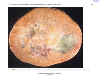C12 Patología del útero, vagina, vulva, ovario, glándula mamaria, del embarazo y de la placenta 331
FIGURA 12-33. Tecoma. Su aspecto es semejante al del fibroma, pero muestra color amarillo por su elevado contenido de hormonas esteroides. Se trata de un tumor funcionante.
© 2007 Editorial Médica Panamericana, S.A de C.V.
Cisfarm
 