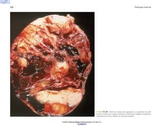 332 Patología especial
FIGURA 12-34. Tumor de células de la granulosa. La superficie de corte
muestra numerosos espacios quísticos rellenos por coágulos sanguíneos
separados por zonas sólidas de color gris-amarillo.
© 2007 Editorial Médica Panamericana, S.A de C.V.
Cisfarm
 