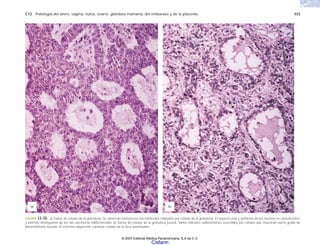 C12 Patología del útero, vagina, vulva, ovario, glándula mamaria, del embarazo y de la placenta 333
FIGURA 12-35. a) Tumor de células de la granulosa. Se observan numerosos microfolículos rodeados por células de la granulosa. El aspecto oval y uniforme de los núcleos es característico
y permite distinguirlos de los del carcinoma indiferenciado. b) Tumor de células de la granulosa juvenil. Varios folículos rudimentarios revestidos por células que muestran cierto grado de
pleomorfismo nuclear. El estroma adyacente contiene células de la teca luteinizadas.
(b)
(a)
© 2007 Editorial Médica Panamericana, S.A de C.V.
Cisfarm
 