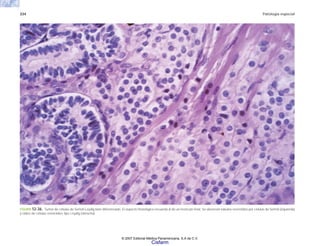 334 Patología especial
FIGURA 12-36. Tumor de células de Sertoli-Leydig bien diferenciado. El aspecto histológico recuerda al de un testículo fetal. Se observan túbulos revestidos por células de Sertoli (izquierda)
y nidos de células esteroides tipo Leydig (derecha).
© 2007 Editorial Médica Panamericana, S.A de C.V.
Cisfarm
 