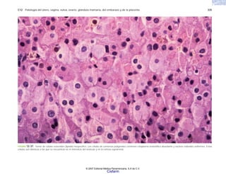 C12 Patología del útero, vagina, vulva, ovario, glándula mamaria, del embarazo y de la placenta 335
FIGURA 12-37. Tumor de células esteroides (lipoide) inespecífico. Las células de contornos poligonales contienen citoplasma eosinofílico abundante y núcleos redondos uniformes. Estas
células son idénticas a las que se encuentran en el intersticio del testículo y en la corteza suprarrenal.
© 2007 Editorial Médica Panamericana, S.A de C.V.
Cisfarm
 