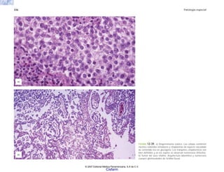 336 Patología especial
FIGURA 12-39. a) Disgerminoma ovárico. Las células contienen
núcleos redondos inmaduros y citoplasmas de aspecto vacuolado
de contenido rico en glucógeno. Los márgenes citoplásmicos son
bien definidos y en los septos se observan numerosos linfocitos.
b) Tumor del saco vitelino. Arquitectura laberíntica y numerosos
cuerpos glomeruloides de Schiller-Duval.
(b)
(a)
© 2007 Editorial Médica Panamericana, S.A de C.V.
Cisfarm
 