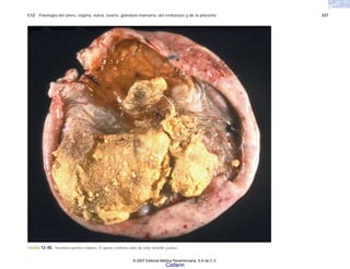 C12 Patología del útero, vagina, vulva, ovario, glándula mamaria, del embarazo y de la placenta 337
FIGURA 12-40. Teratoma quístico maduro. El quiste contiene sebo de color amarillo y pelos.
© 2007 Editorial Médica Panamericana, S.A de C.V.
Cisfarm
 
