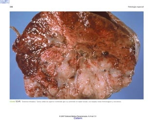 338 Patología especial
FIGURA 12-41. Teratoma inmaduro. Tumor sólido de aspecto cerebroide (por su contenido en tejido neural), con amplias zonas hemorrágicas y necróticas.
© 2007 Editorial Médica Panamericana, S.A de C.V.
Cisfarm
 