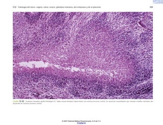 C12 Patología del útero, vagina, vulva, ovario, glándula mamaria, del embarazo y de la placenta 339
FIGURA 12-42. Teratoma inmaduro grado histológico III. Tejido neural inmaduro hipercelular con extensa necrosis central. Se observan neurotúbulos que simulan estadios normales del
desarrollo de sistema nervioso central.
© 2007 Editorial Médica Panamericana, S.A de C.V.
Cisfarm
 