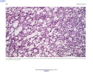 340 Patología especial
FIGURA 12-43. Tumor de Krukenberg. Se observan nidos de células mucosecretoras en anillo de sello rodeadas por una llamativa proliferación fibroblástica del estroma. El tumor primario
se encontraba en el antro gástrico.
© 2007 Editorial Médica Panamericana, S.A de C.V.
Cisfarm
 
