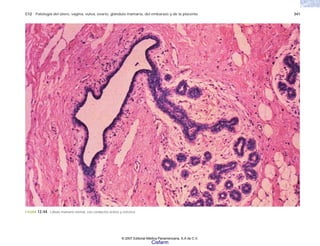 C12 Patología del útero, vagina, vulva, ovario, glándula mamaria, del embarazo y de la placenta 341
FIGURA 12-44. Lóbulo mamario normal, con conductos ácinos y estroma.
© 2007 Editorial Médica Panamericana, S.A de C.V.
Cisfarm
 