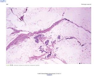 342 Patología especial
FIGURA 12-45. Involución mamaria con atrofia del componente epitelial.
© 2007 Editorial Médica Panamericana, S.A de C.V.
Cisfarm
 