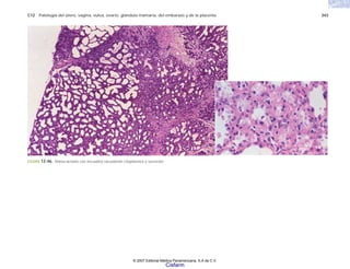 C12 Patología del útero, vagina, vulva, ovario, glándula mamaria, del embarazo y de la placenta 343
FIGURA 12-46. Mama lactante con (recuadro) vacuolación citoplásmica y secreción.
© 2007 Editorial Médica Panamericana, S.A de C.V.
Cisfarm
 