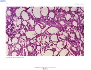344 Patología especial
FIGURA 12-47. Necrosis grasa de la mama.
© 2007 Editorial Médica Panamericana, S.A de C.V.
Cisfarm
 