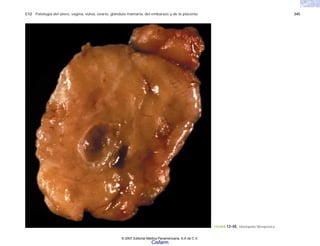 C12 Patología del útero, vagina, vulva, ovario, glándula mamaria, del embarazo y de la placenta 345
FIGURA 12-48. Mastopatía fibroquística.
© 2007 Editorial Médica Panamericana, S.A de C.V.
Cisfarm
 