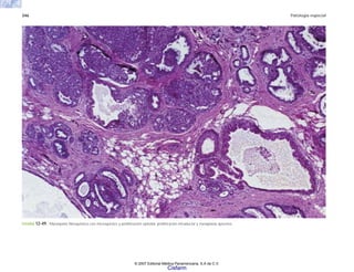 346 Patología especial
FIGURA 12-49. Mastopatía fibroquística con microquistes y proliferación epitelial, proliferación intraductal y metaplasia apocrina.
© 2007 Editorial Médica Panamericana, S.A de C.V.
Cisfarm
 