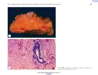 C12 Patología del útero, vagina, vulva, ovario, glándula mamaria, del embarazo y de la placenta 347
FIGURA 12-50. Ginecomastia. a) Aspecto macroscópico de hipertrofia. b)
Histología con hiperplasia ductal y estromal.
(b)
(a)
© 2007 Editorial Médica Panamericana, S.A de C.V.
Cisfarm
 
