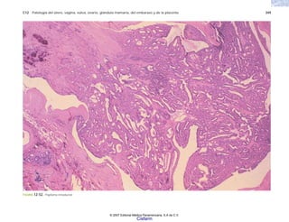 C12 Patología del útero, vagina, vulva, ovario, glándula mamaria, del embarazo y de la placenta 349
FIGURA 12-52. Papiloma intraductal.
© 2007 Editorial Médica Panamericana, S.A de C.V.
Cisfarm
 
