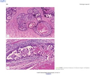 350 Patología especial
FIGURA 12-53. Carcinoma intraductal. a) Conductos íntegros. b) Anaplasia
del epitelio ductal.
(b)
(a)
© 2007 Editorial Médica Panamericana, S.A de C.V.
Cisfarm
 
