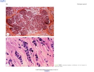 352 Patología especial
FIGURA 12-55. Carcinoma lobulillar. a) Infiltrante. b) Con invasión en
hileras de células.
(b)
(a)
© 2007 Editorial Médica Panamericana, S.A de C.V.
Cisfarm
 