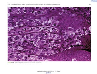 C12 Patología del útero, vagina, vulva, ovario, glándula mamaria, del embarazo y de la placenta 353
FIGURA 12-56. Enfermedad de Paget del pezón con invasión de epidermis.
© 2007 Editorial Médica Panamericana, S.A de C.V.
Cisfarm
 