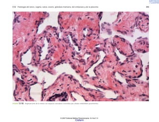 C12 Patología del útero, vagina, vulva, ovario, glándula mamaria, del embarazo y de la placenta 355
FIGURA 12-58. Angiosarcoma de la mama con espacios vasculares revestidos por células endoteliales prominentes.
© 2007 Editorial Médica Panamericana, S.A de C.V.
Cisfarm
 