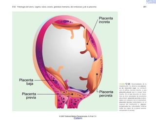 C12 Patología del útero, vagina, vulva, ovario, glándula mamaria, del embarazo y de la placenta 357
FIGURA 12-60. Anormalidades de la
implantación. Se observa una placen-
ta de inserción baja, en contacto
con el orificio cervical interno, y una
placenta previa que lo ocluye total-
mente. En el lado derecho se mues-
tran las tres variedades de acretismo
placentario: placenta accreta (vellosi-
dades en contacto con el miometrio),
placenta increta (vellosidades en el
espesor del miometrio) y placen-
ta percreta (las vellosidades infiltran
todas las capas de la pared uterina,
incluyendo la serosa).
© 2007 Editorial Médica Panamericana, S.A de C.V.
Cisfarm
 