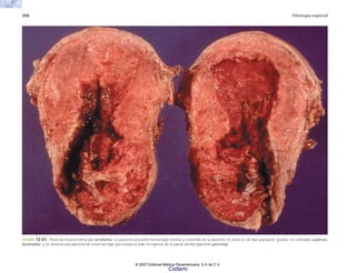 358 Patología especial
FIGURA 12-61. Pieza de histerectomía por acretismo. La paciente presentó hemorragia intensa y retención de la placenta. El útero es de tipo puerperal, grande, no contraído (subinvo-
lucionado), y se observa una placenta de inserción baja que involucra todo el espesor de la pared uterina (placenta percreta).
© 2007 Editorial Médica Panamericana, S.A de C.V.
Cisfarm
 