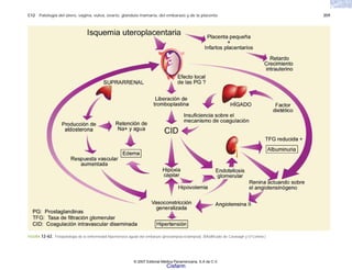 C12 Patología del útero, vagina, vulva, ovario, glándula mamaria, del embarazo y de la placenta 359
FIGURA 12-62. Fisiopatología de la enfermedad hipertensiva aguda del embarazo (preclampsia-eclampsia). (Modificado de Cavanagh y O’Connor.)
© 2007 Editorial Médica Panamericana, S.A de C.V.
Cisfarm
 