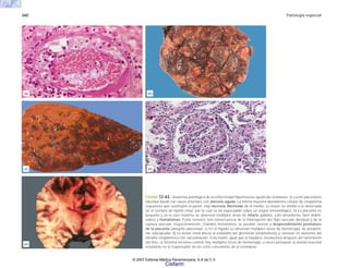360 Patología especial
FIGURA 12-63. Anatomía patológica de la enfermedad hipertensiva aguda del embarazo. a) Lecho placentario
(decidua basal) con vasos arteriales con aterosis aguda. La íntima muestra abundantes células de citoplasma
espumoso que sustituyen la pared. Hay necrosis fibrinoide de la media. La lesión es similar a la observada
en el rechazo de injerto renal, por lo cual se ha especulado sobre un origen inmunológico. b) La placenta es
pequeña y en la cara materna se observan múltiples áreas de infarto (pálidos, café amarillento, bien delimi-
tados) y hematomas. Estas lesiones son consecuencia de la interrupción del flujo vascular decidual y de la
ruptura vascular, respectivamente. Grandes hematomas se pueden asociar a desprendimiento prematuro
de la placenta (abruptio placentae). c) En el hígado se observan múltiples áreas de hemorragia, de predomi-
nio subcapsular. d) La lesión renal afecta al endotelio del glomérulo (endoteliosis) y consiste en aumento del
tamaño citoplásmico con vacuolización. Esta lesión, igual que la hepática, involuciona después del nacimiento
del feto. e) Sistema nervioso central: hay múltiples focos de hemorragia, a veces petequial; la anoxia neuronal
resultante es la responsable de las crisis convulsivas de la eclampsia.
(a) (b)
(c) (d)
(e)
© 2007 Editorial Médica Panamericana, S.A de C.V.
Cisfarm
 