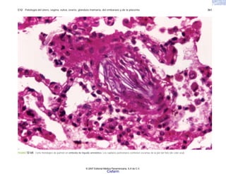 C12 Patología del útero, vagina, vulva, ovario, glándula mamaria, del embarazo y de la placenta 361
FIGURA 12-64. Corte histológico de pulmón en embolia de líquido amniótico. Los capilares pulmonares contienen escamas de la piel del feto (de color azul).
© 2007 Editorial Médica Panamericana, S.A de C.V.
Cisfarm
 