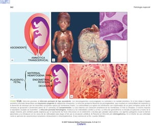 362 Patología especial
FIGURA 12-65. Infección perinatal. a) Infección perinatal de tipo ascendente. Los microorganismos cervicovaginales se extienden a la cavidad amniótica. Si el feto inhala el líquido
amniótico infectado desarrollará una neumonía congénita de adquisición intrauterina. La infección producirá liberación de prostaglandinas, que resultará en contractilidad del miometrio y
la liberación de elastasas por los neutrófilos ocasionará ruptura de membranas fetales. La contractilidad y la ruptura de membranas son responsables de un parto inmaduro (antes de 28
semanas de gestación) o pretérmino (antes de 37 semanas). b) Corioamnionitis. La cara materna con coloración amarillenta de las membranas. El feto es inmaduro. El inserto muestra
el abundante exudado de neutrófilos. c) Infección perinatal hematógena. Involucra a las vellosidades coriales y al feto. La infección generalmente es llevada a la placenta a través de la
sangre materna, pero también puede originarse por la reactivación de focos infecciosos en el endometrio o decidua (por ejemplo tuberculosis). Los agentes patógenos cruzan la barrera
placentaria y se introducen en los vasos de las vellosidades para llegar al feto por la circulación umbilical. d) Placenta en infección por citomegalovirus. En el interior de una vellosidad
corial se aprecian las características inclusiones intranucleares e intracitoplásmicas. (Caso cortesía de la Dra. Lourdes Molinar.)
(b)
(a)
(c) (d)
© 2007 Editorial Médica Panamericana, S.A de C.V.
Cisfarm
 