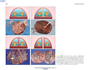 364 Patología especial
FIGURA 12-67. Tipos de placenta gemelar. a) Monocorial
monoamniótica. Los dos fetos están en la misma cavidad amnió-
tica y son monocigotos. b) Monocorial diamniótica. Los gemelos
son monocigotos, cada uno en una diferente bolsa amniótica. c)
Dicorial fusionada. Son dos placentas estrechamente unidas; los
gemelos pueden ser dicigotos (85% de los casos) o monocigotos
(15%). d) Dicorial separada. Se aprecian dos placentas aisladas.
La correlación de cigocidad es igual al tipo anterior.
(a) (b)
(d)
(c)
© 2007 Editorial Médica Panamericana, S.A de C.V.
Cisfarm
 