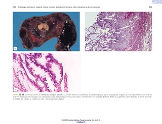 C12 Patología del útero, vagina, vulva, ovario, glándula mamaria, del embarazo y de la placenta 365
FIGURA 12-68. a) Trompa uterina en embarazo ectópico tubario. La porción ampular está dilatada, la pared congestiva. La luz ocupada por coágulos y el saco gestacional, con embrión
de 8 mm. b) Imagen microscópica: las vellosidades están implantadas en la mucosa tubaria. c) Endometrio con reacción de Arias-Stella. Las glándulas están dilatadas, de borde aserrado,
revestidas por células de citoplasma claro y núcleos grandes atípicos.
(b)
(a)
(c)
© 2007 Editorial Médica Panamericana, S.A de C.V.
Cisfarm
 