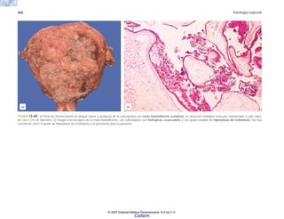 366 Patología especial
FIGURA 12-69. a) Pieza de histerectomía en bloque (útero y producto de la concepción) con mola hidatidiforme completa: se observan múltiples vesículas translúcidas o café claro,
de casi 2 cm de diámetro. b) Imagen microscópica de la mola hidatidiforme. Las vellosidades son hidrópicas, avasculares y con grado variable de hiperplasia del trofoblasto. No hay
correlación entre el grado de hiperplasia del trofoblasto y el pronóstico para la paciente.
(b)
(a)
© 2007 Editorial Médica Panamericana, S.A de C.V.
Cisfarm
 