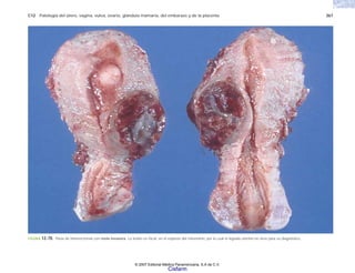 C12 Patología del útero, vagina, vulva, ovario, glándula mamaria, del embarazo y de la placenta 367
FIGURA 12-70. Pieza de histerectomía con mola invasora. La lesión es focal, en el espesor del miometrio, por lo cual el legrado uterino no sirve para su diagnóstico.
© 2007 Editorial Médica Panamericana, S.A de C.V.
Cisfarm
 